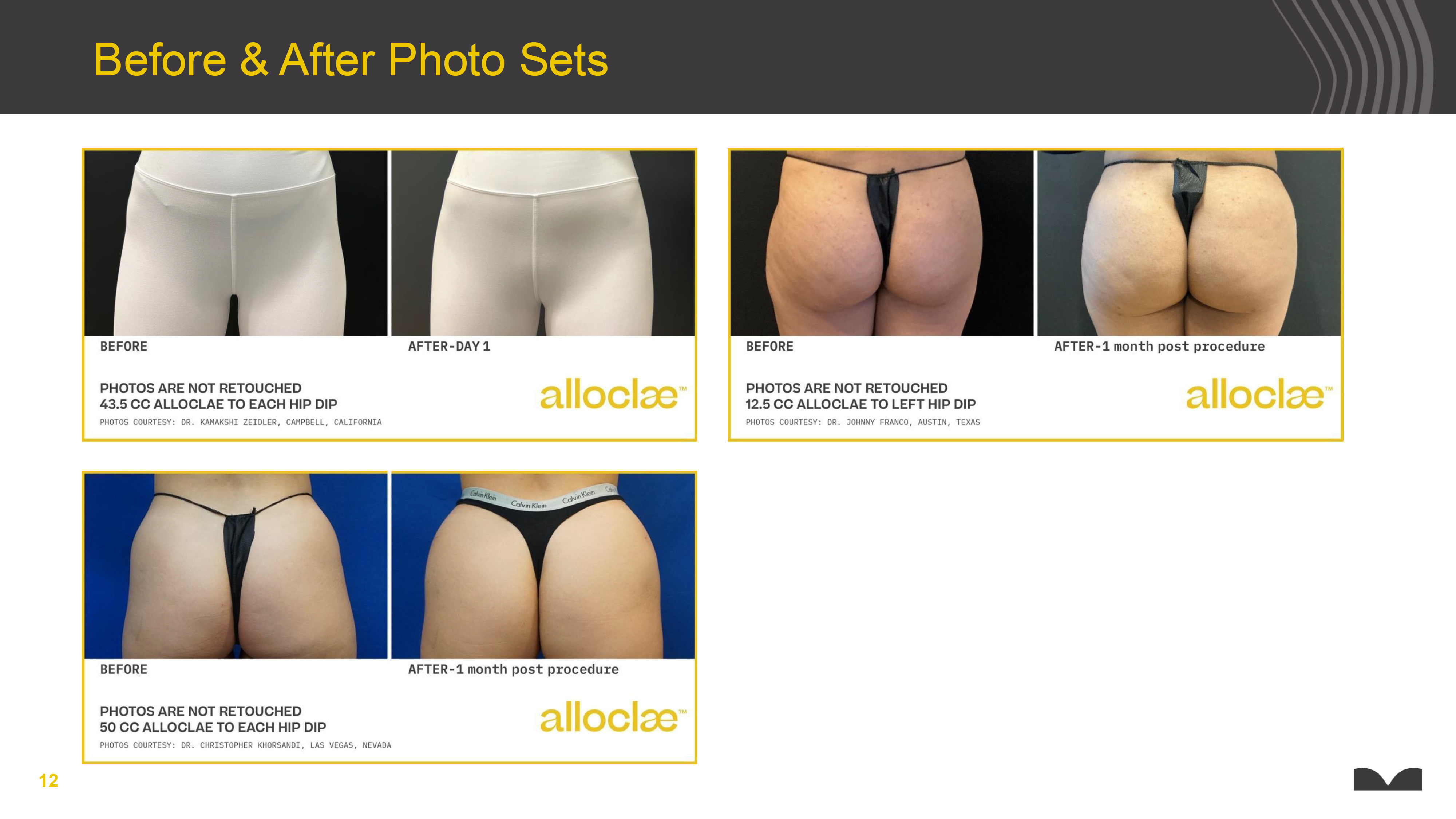 alloClae before and after hip dip and body contouring results