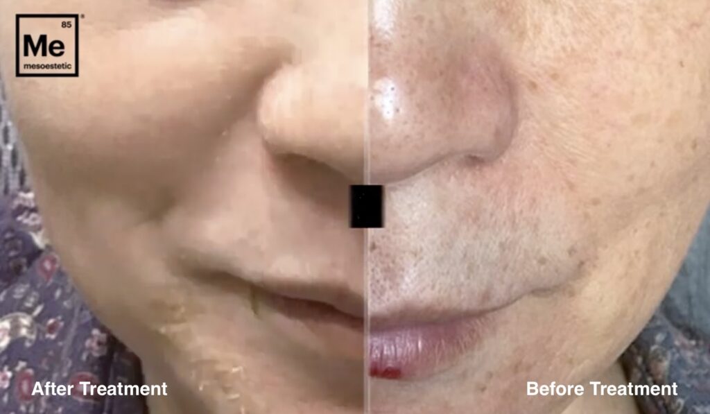 Cosmelan peel la