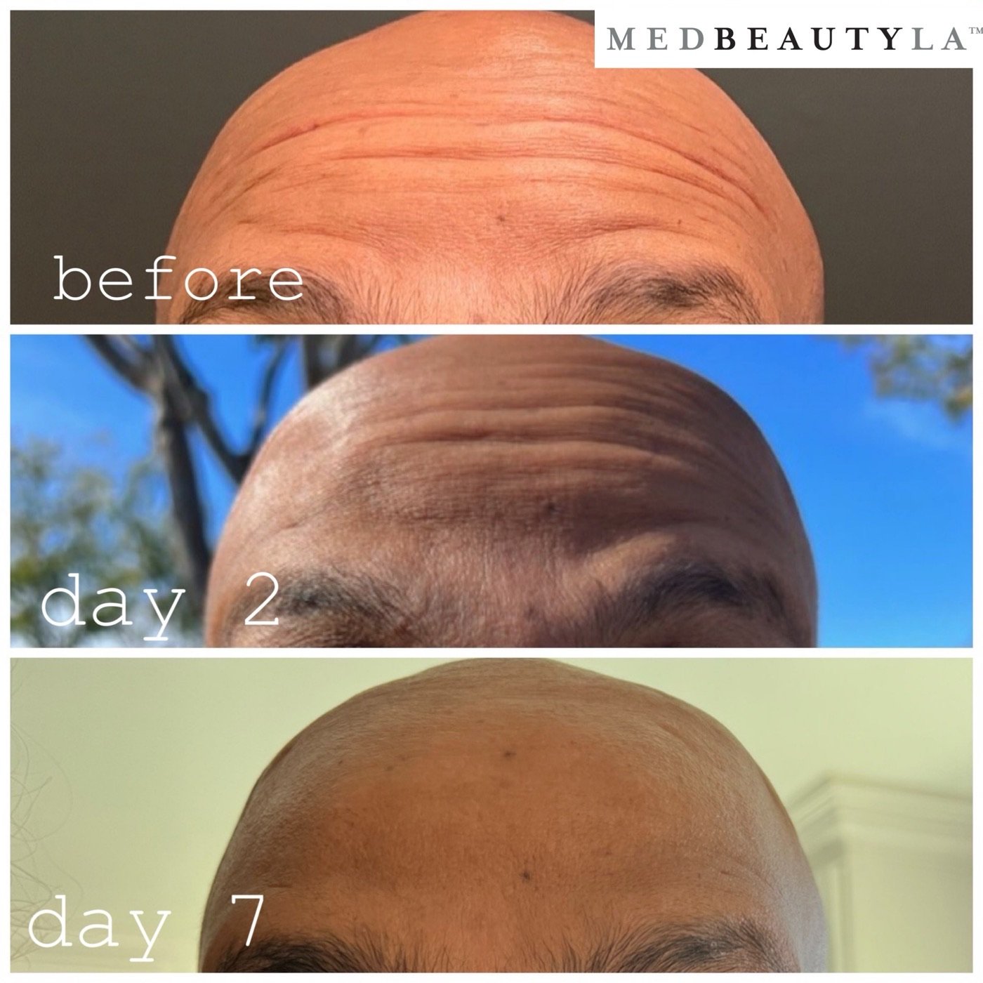 Daxxify results