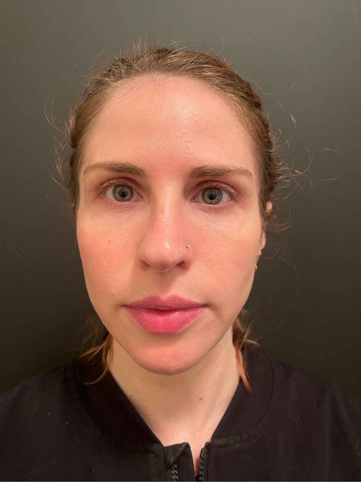 daxxify before and after