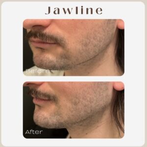 facial balancing jaw los angeles