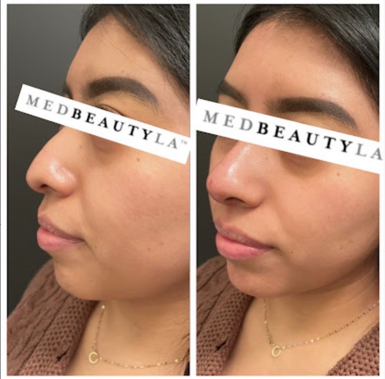 Liquid rhinoplasty before and after at MedBeautyLA, three-quarter view of a more balanced nose with filler