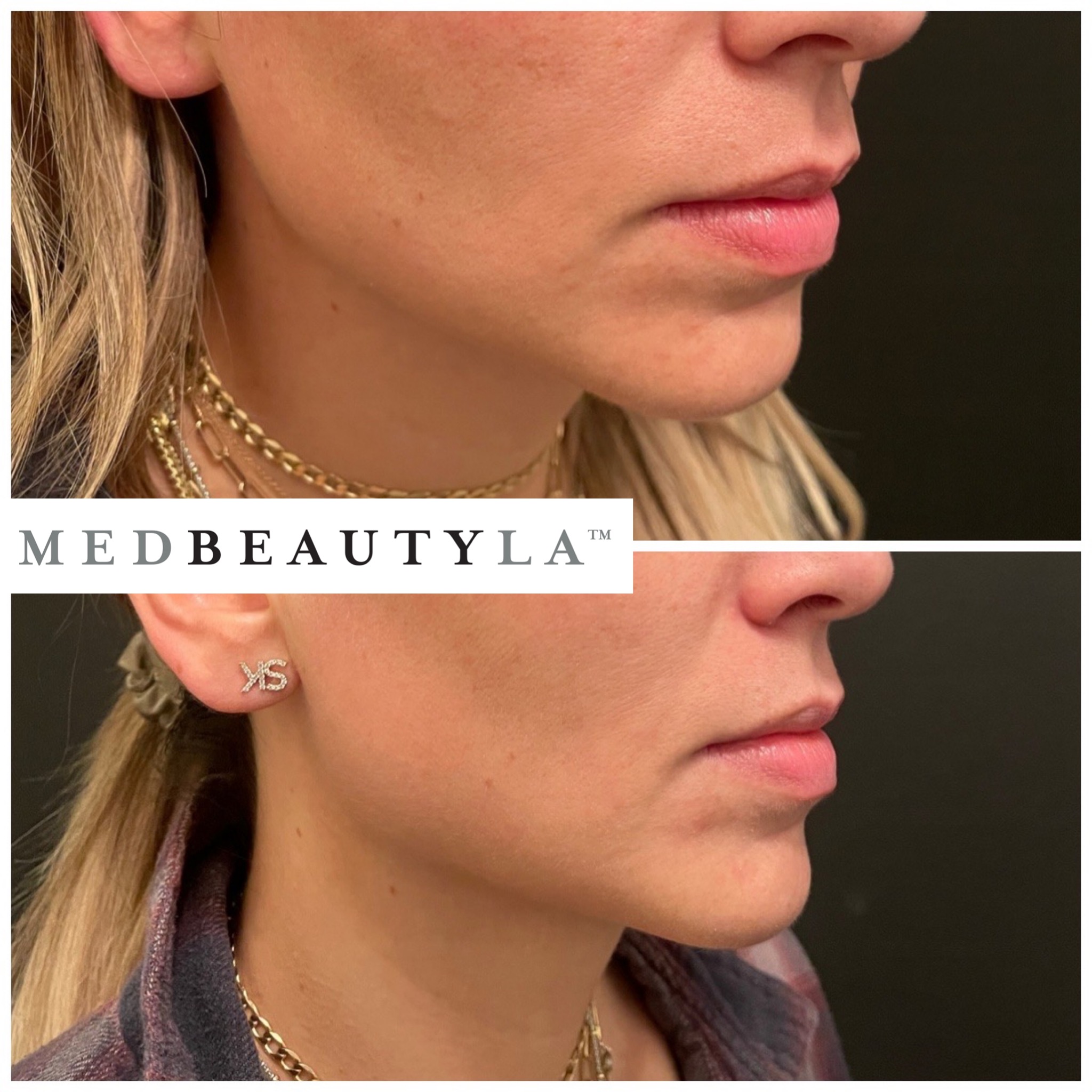 trilift before and after