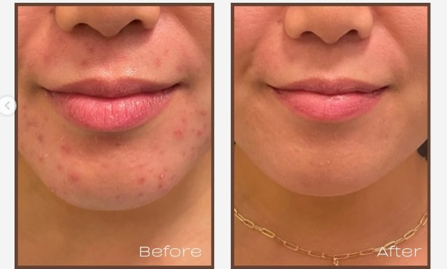 acne treatment downtown la