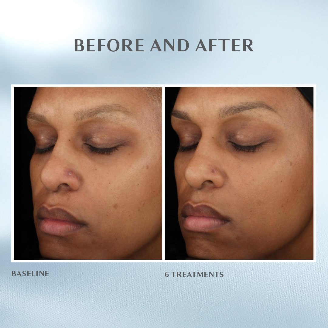 best hydrafacial los angeles