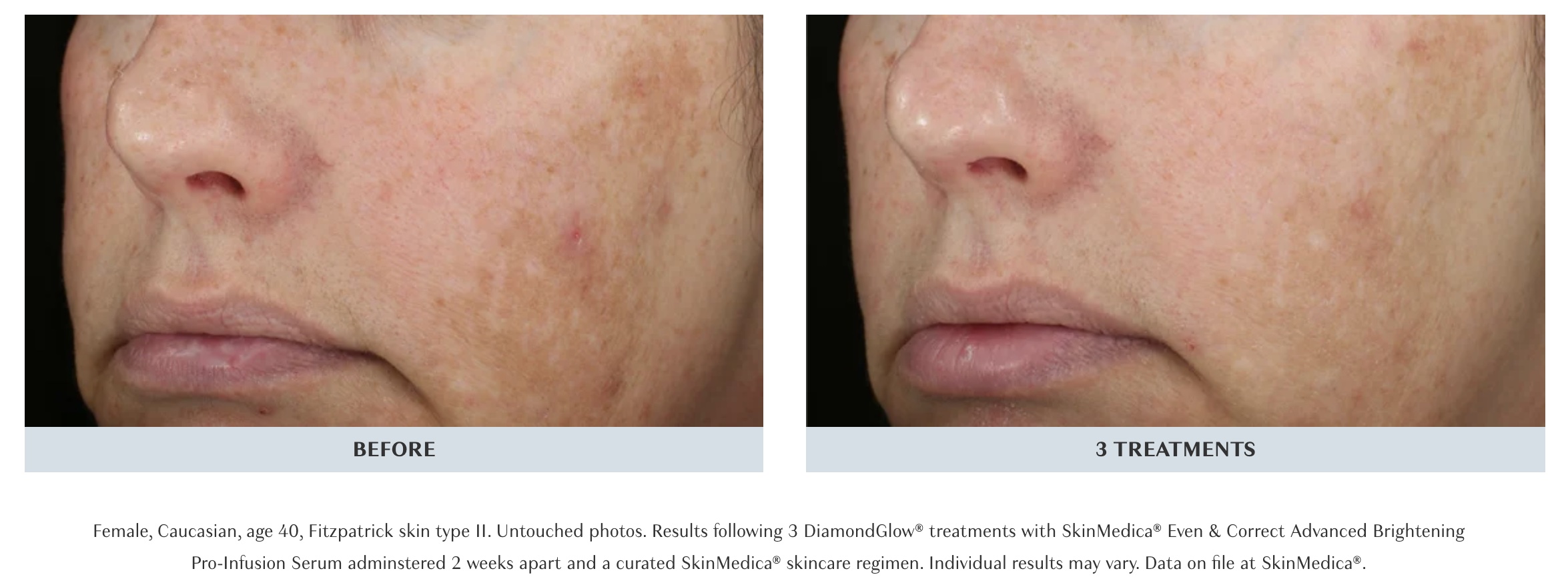 brown spots hydrafacial
