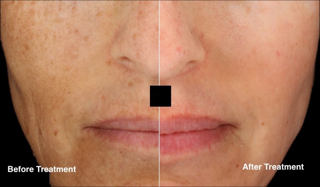 Cosmelan peel before and after photo