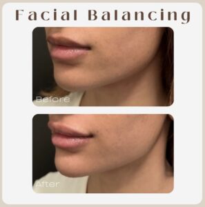 contouring with filler la