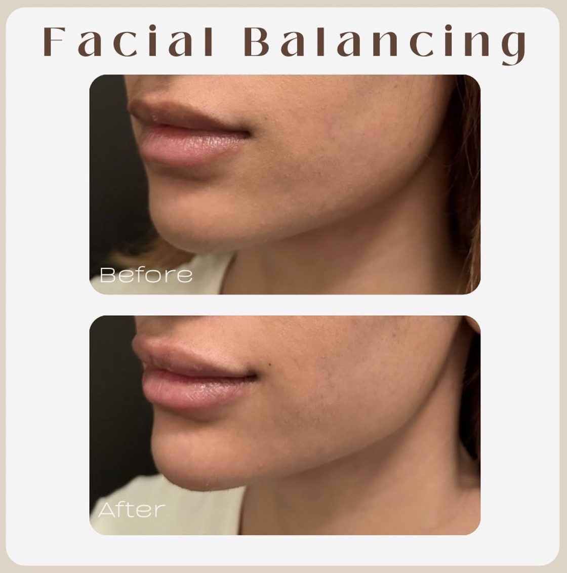 contouring with filler la