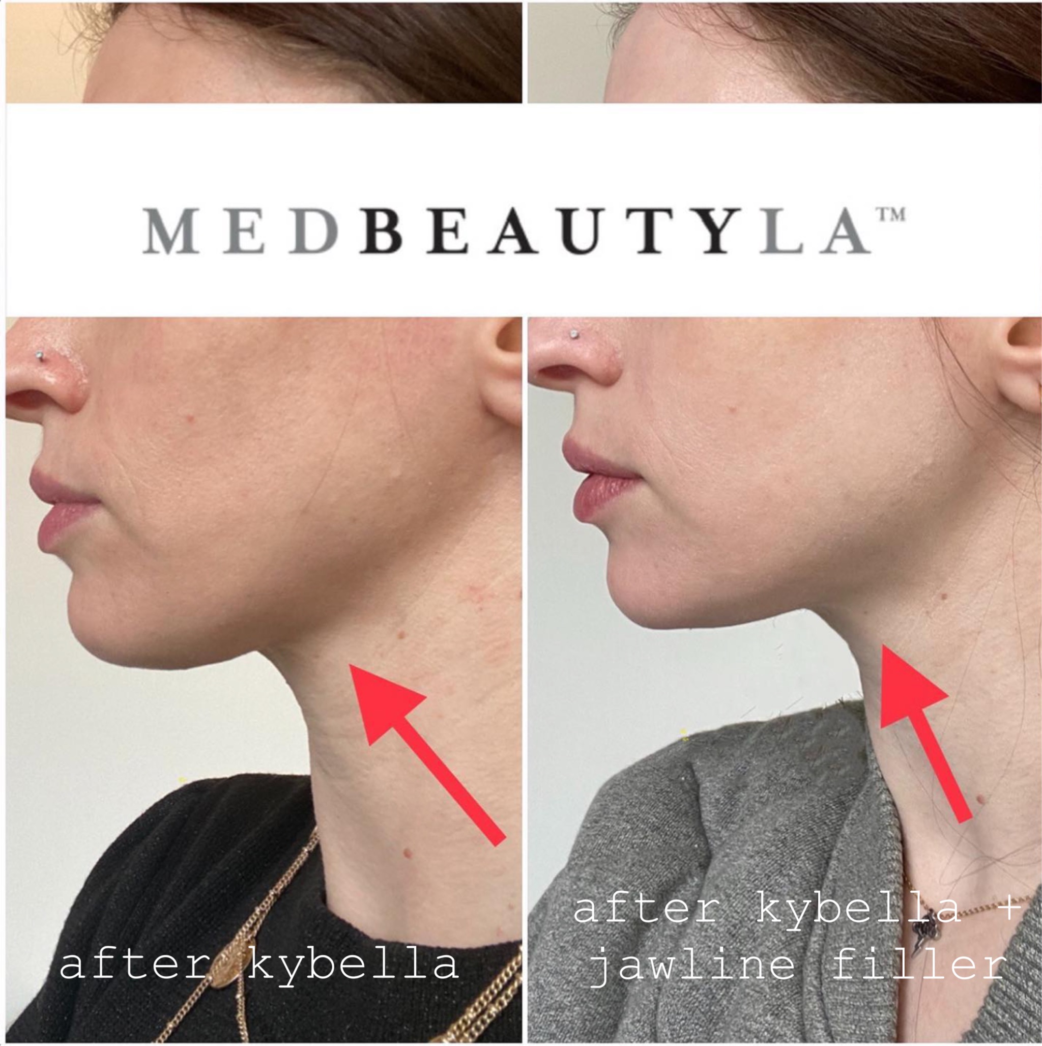 combination jawline treatment
