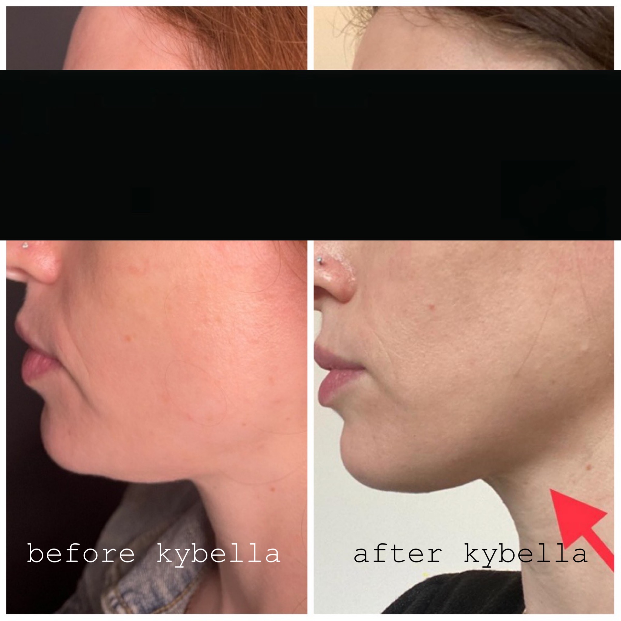 chin fat treatment