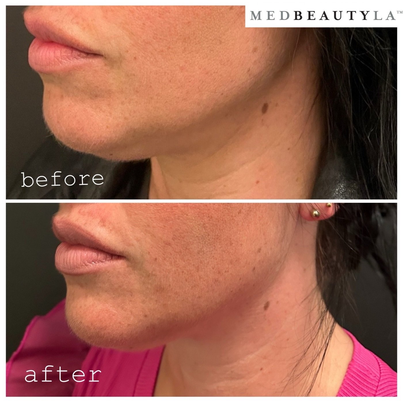 Kybella double chin before and after, female client