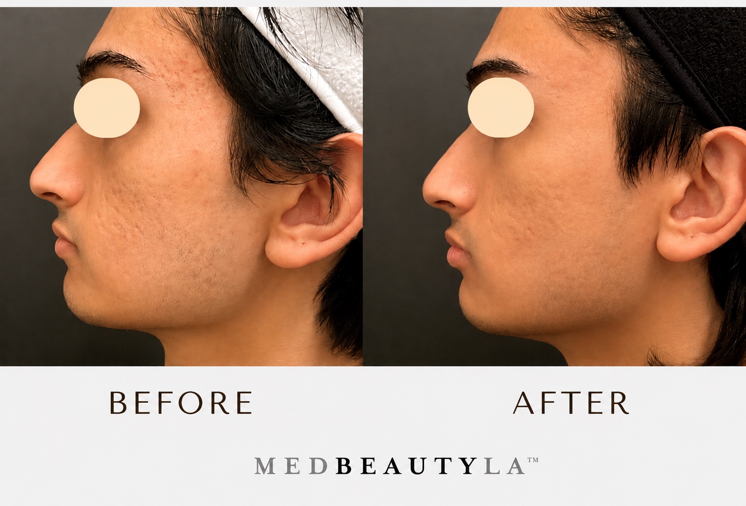 Laser Treatments for Men: Why More Men Are Investing in Better Skin 4