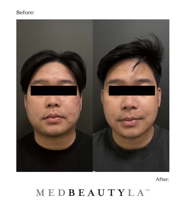 Laser Treatments for Men: Why More Men Are Investing in Better Skin 5