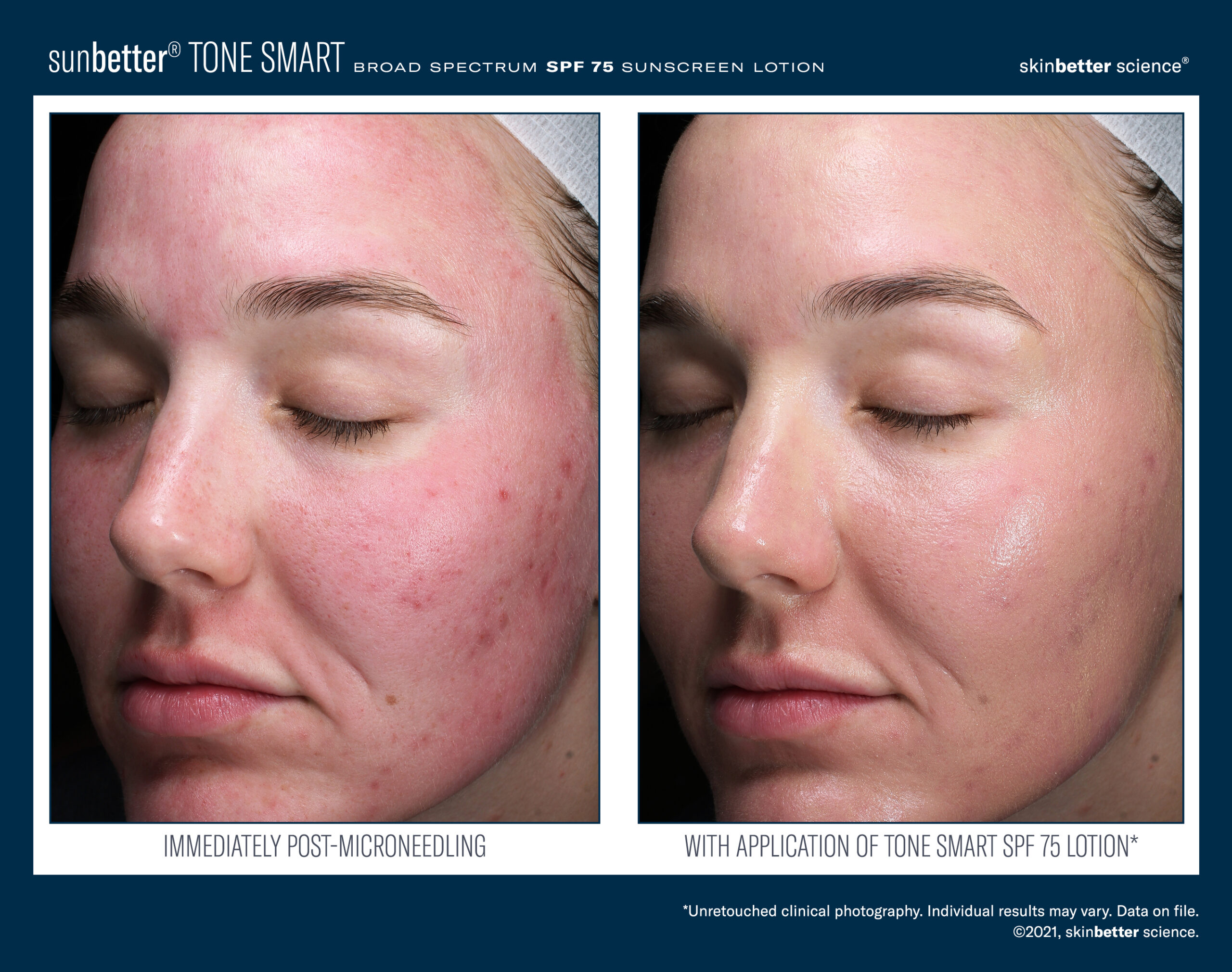 makeup directly after microneedling