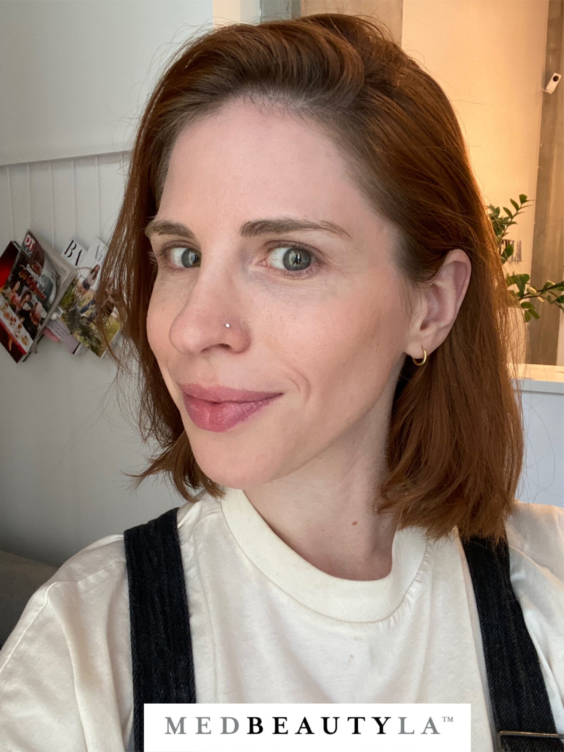 microneedling final results