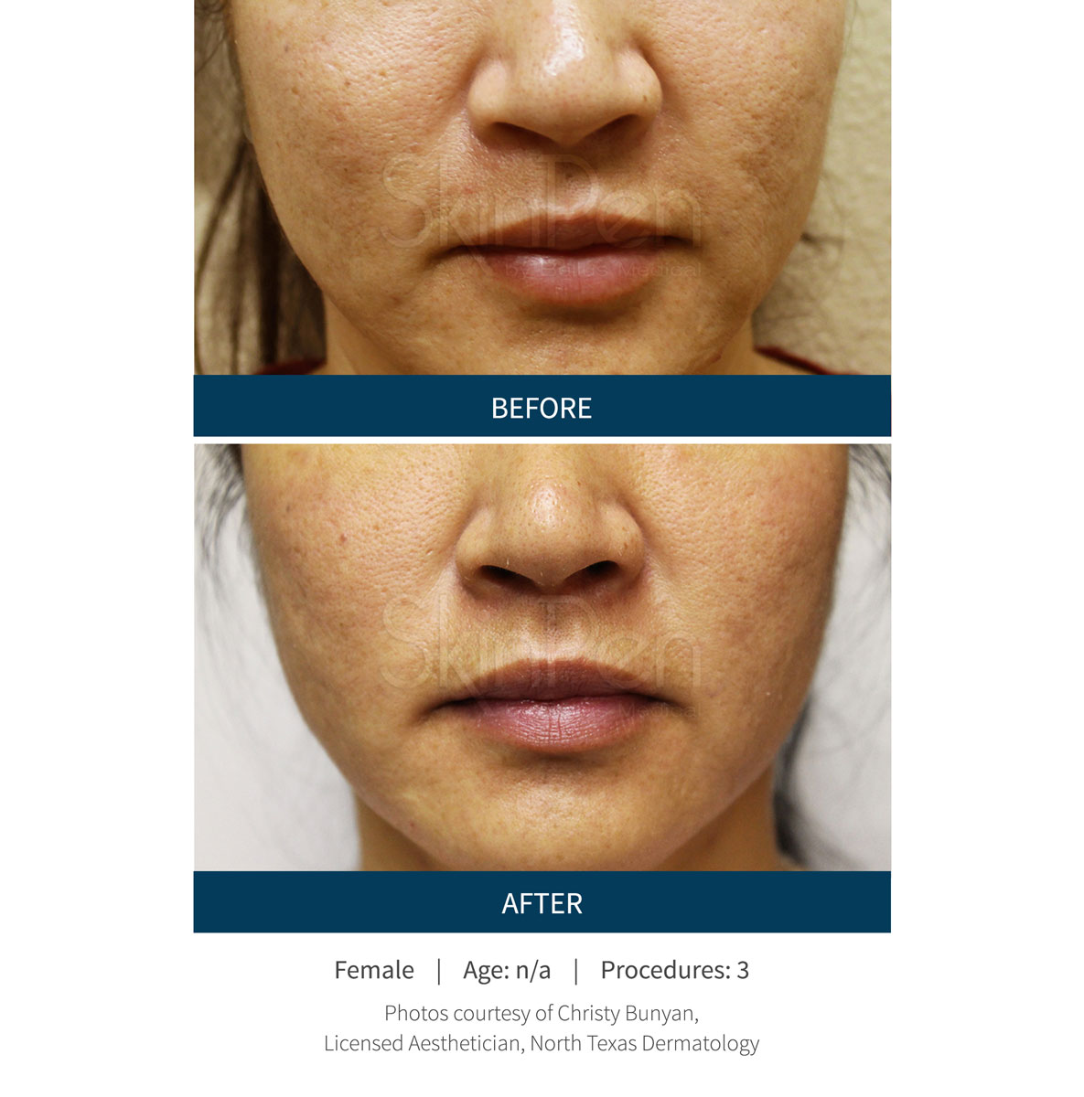 microneedling nasolabial folds