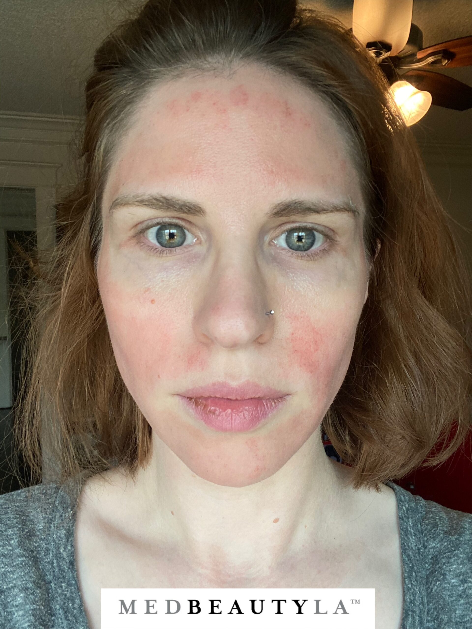 microneedling second day