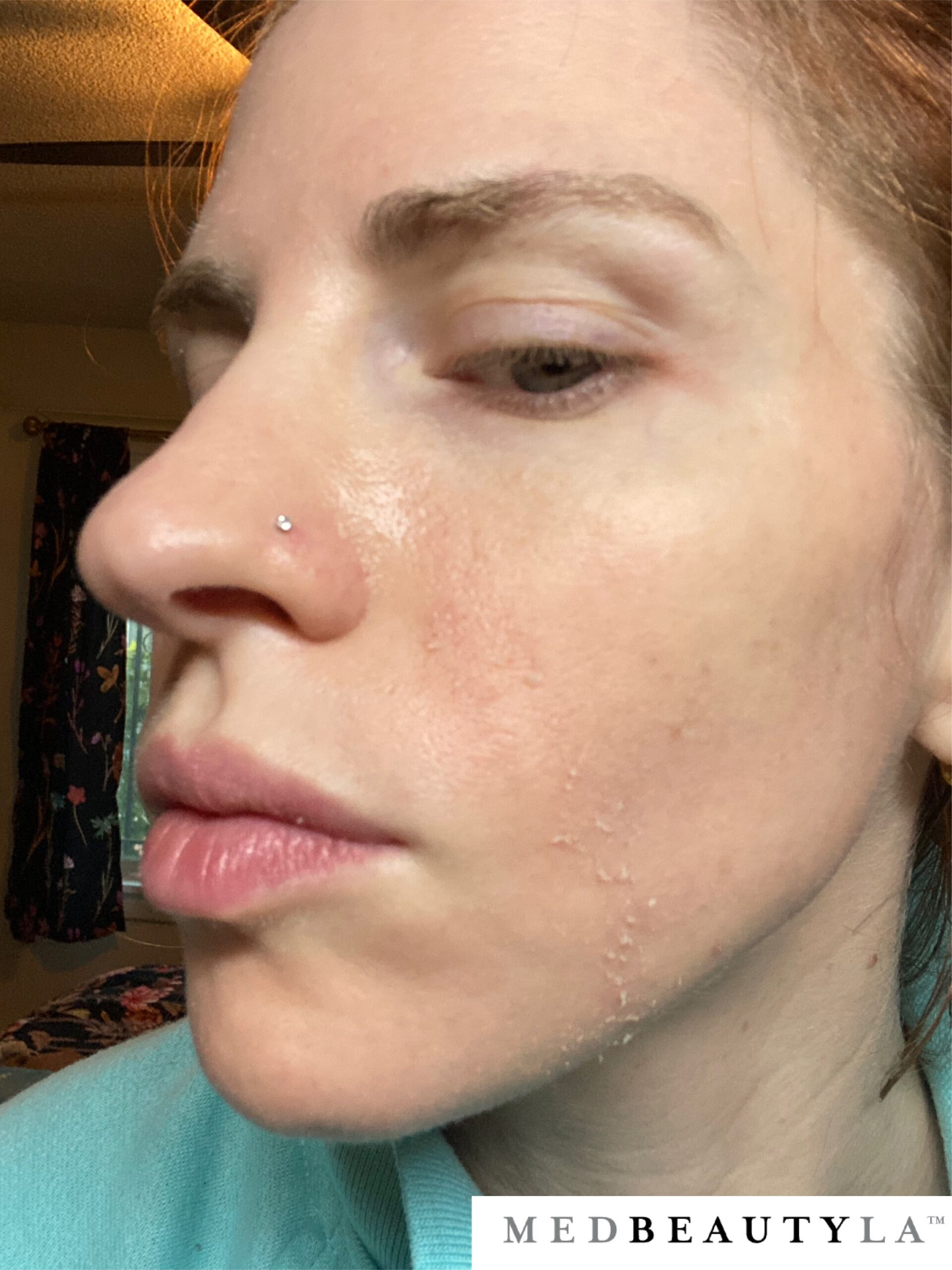 microneedling peeling