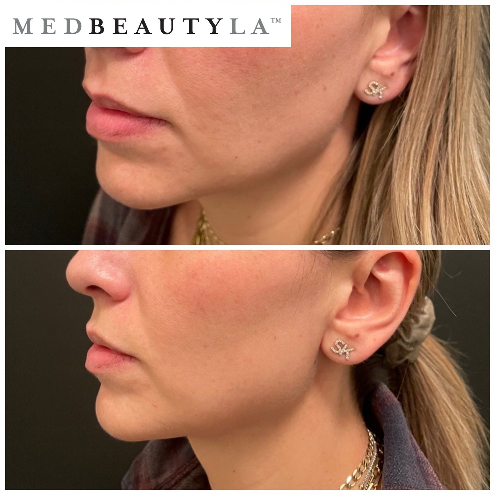 skin laxity in the jowl