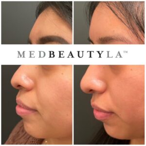 nose filler los angeles