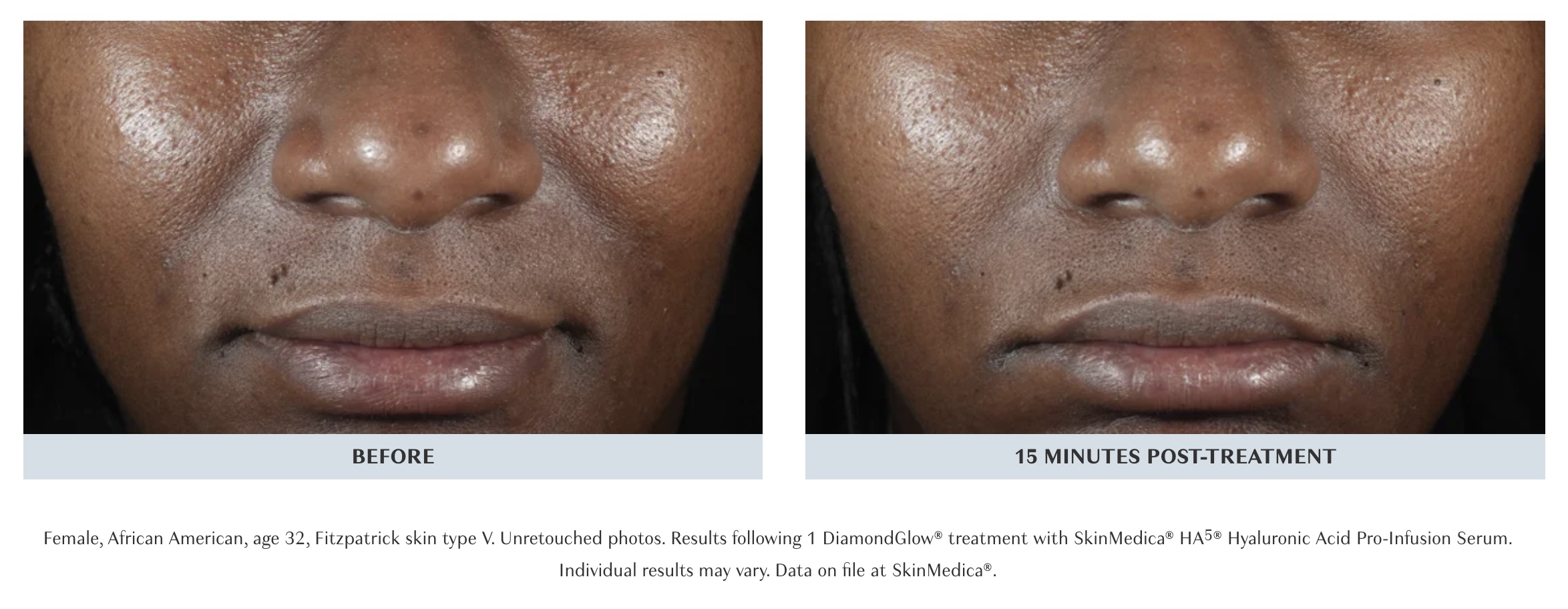 photos hydrafacial versus diamondglow