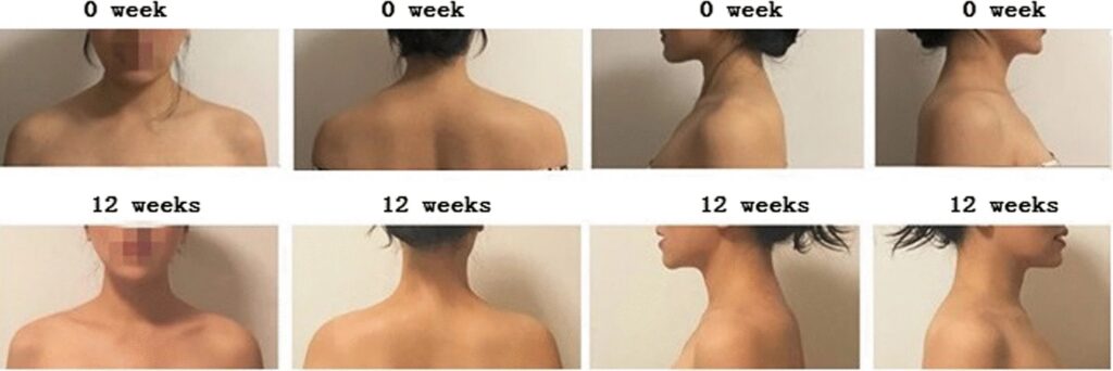 traptox before and after photo