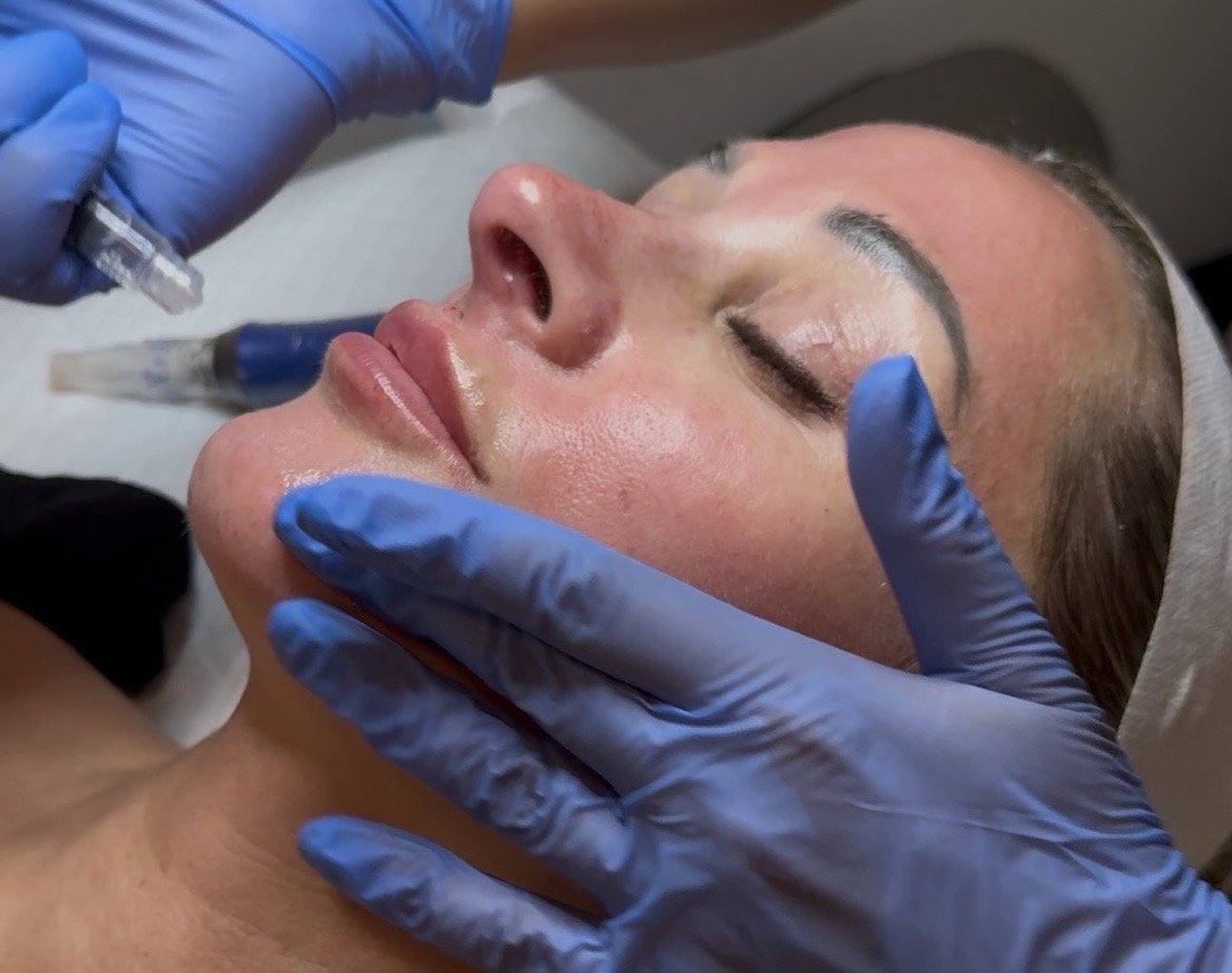 Gloved provider treating a client’s lower face