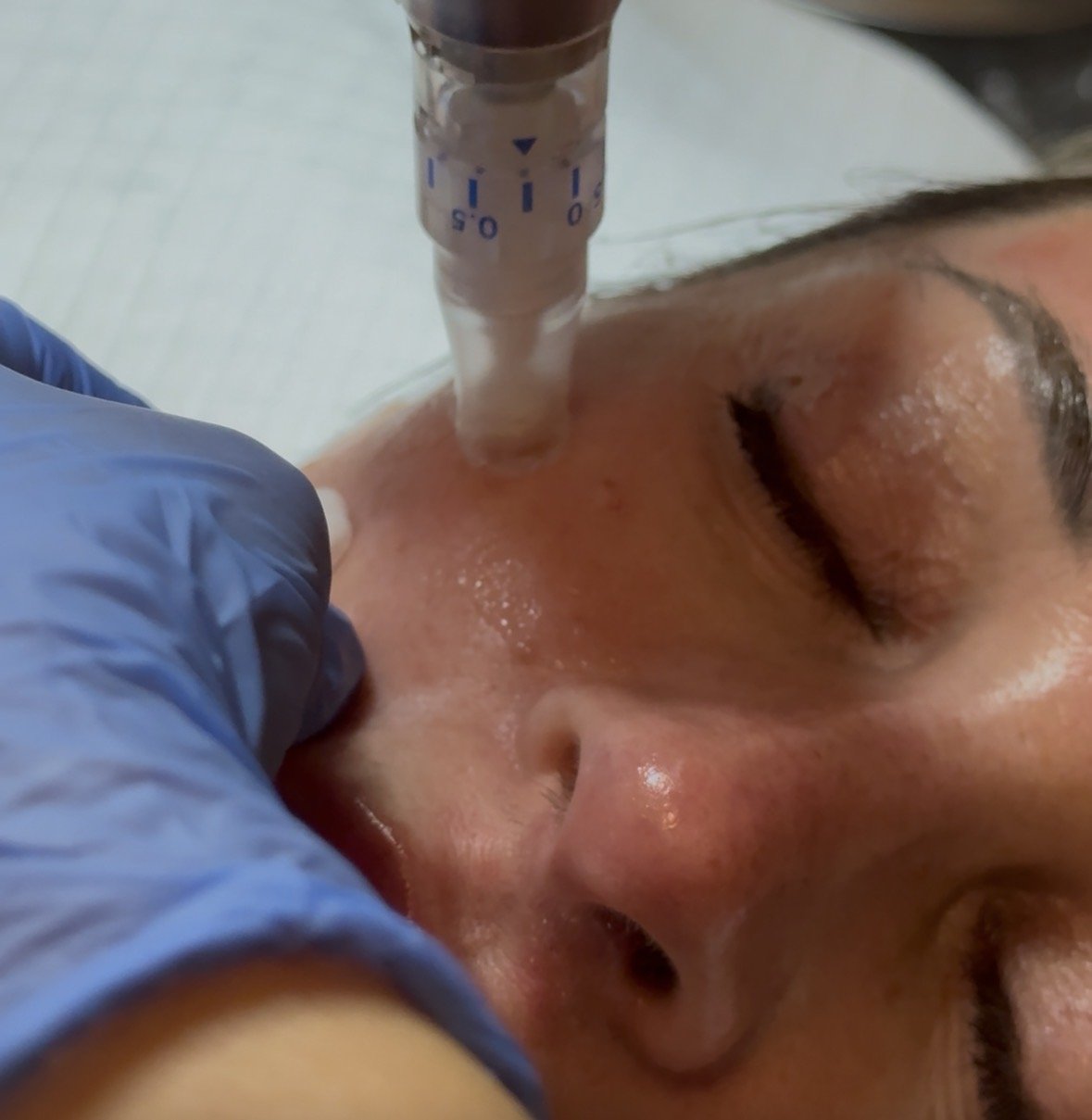 Close-up of a microneedling pen on a client’s face