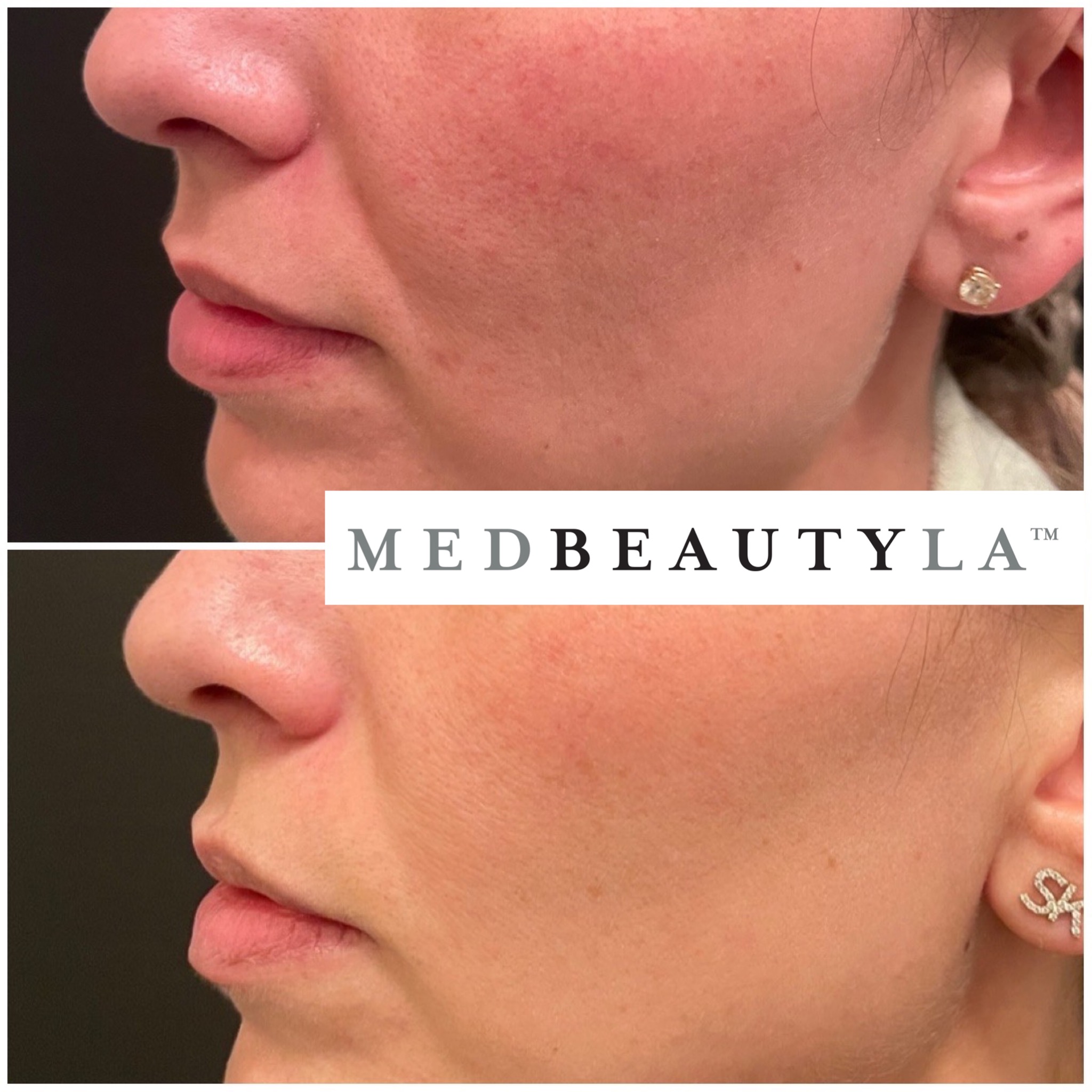 trilift before and after