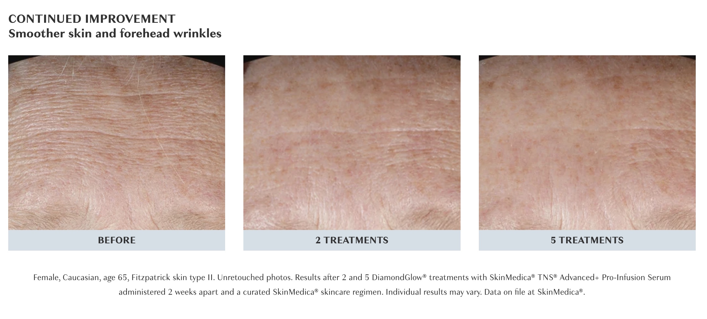 diamondglow vs. hydrafacial wrinkles