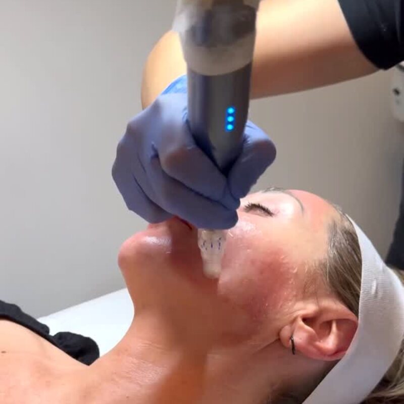 Treatment stacking at MedBeautyLA