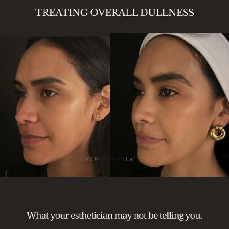 Before and after treating overall dullness