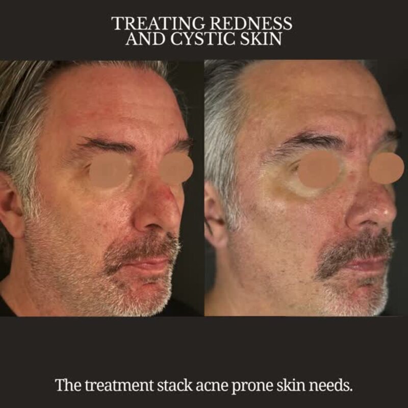 Before and after treating redness and cystic skin