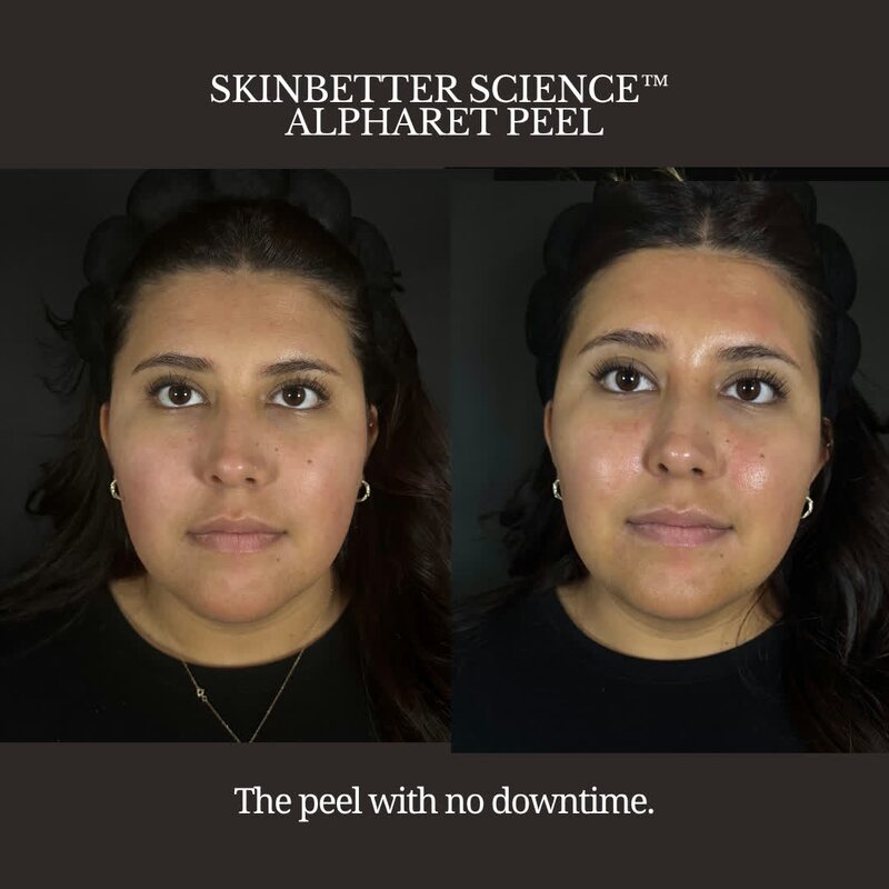 SkinBetter Science AlphaRet Peel before and after