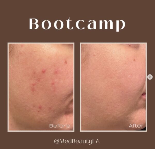 Acne Bootcamp before and after at MedBeautyLA: scattered red breakouts on the cheek clear to smooth, even skin