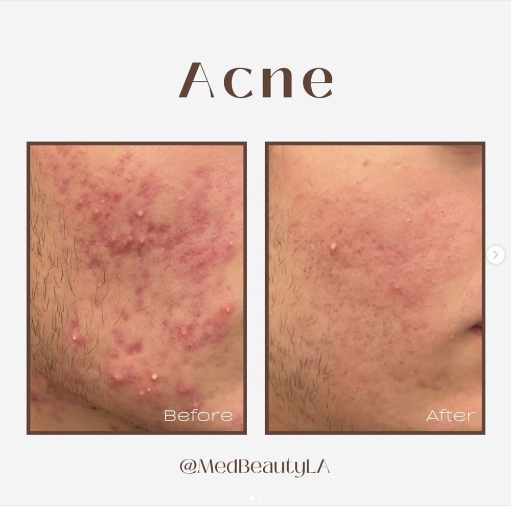Acne before and after at MedBeautyLA: a cheek covered in inflamed red breakouts and whiteheads becomes much calmer and clearer