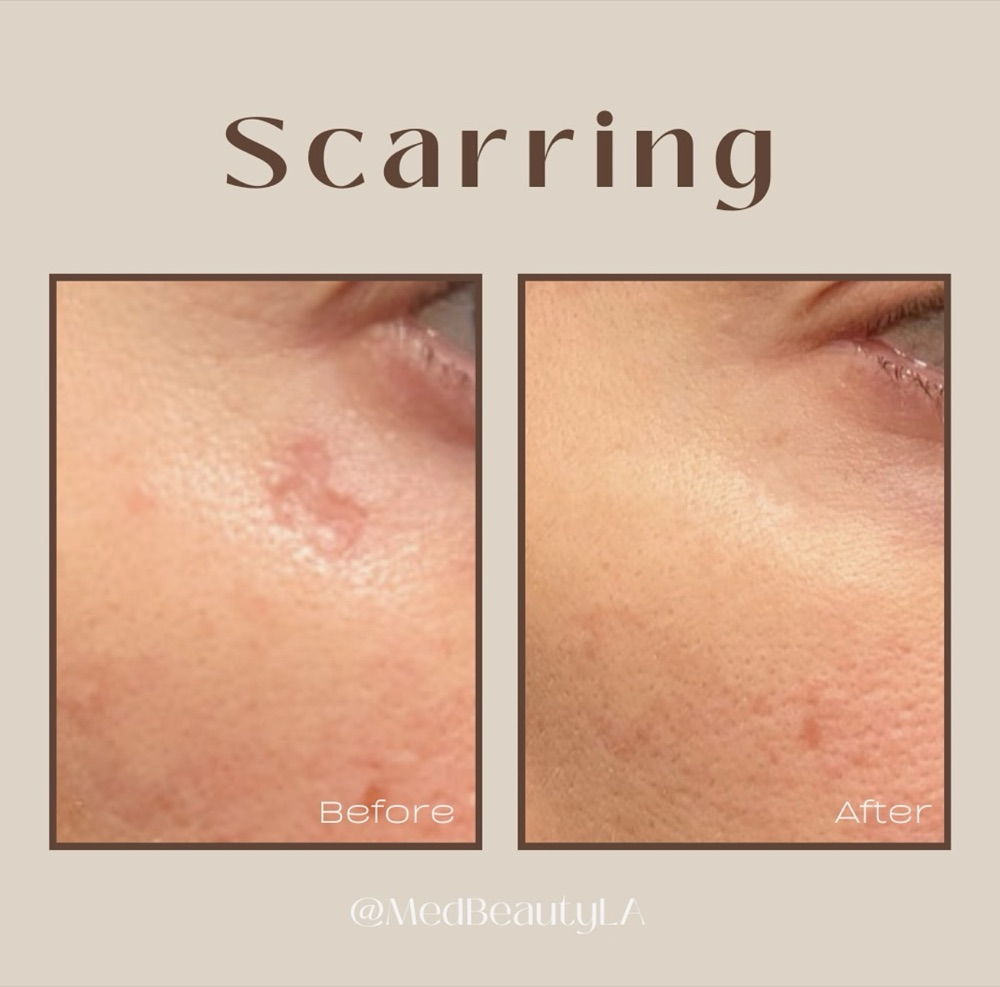 Acne scar before and after at MedBeautyLA: a raised, textured scar under the eye fades into smooth skin