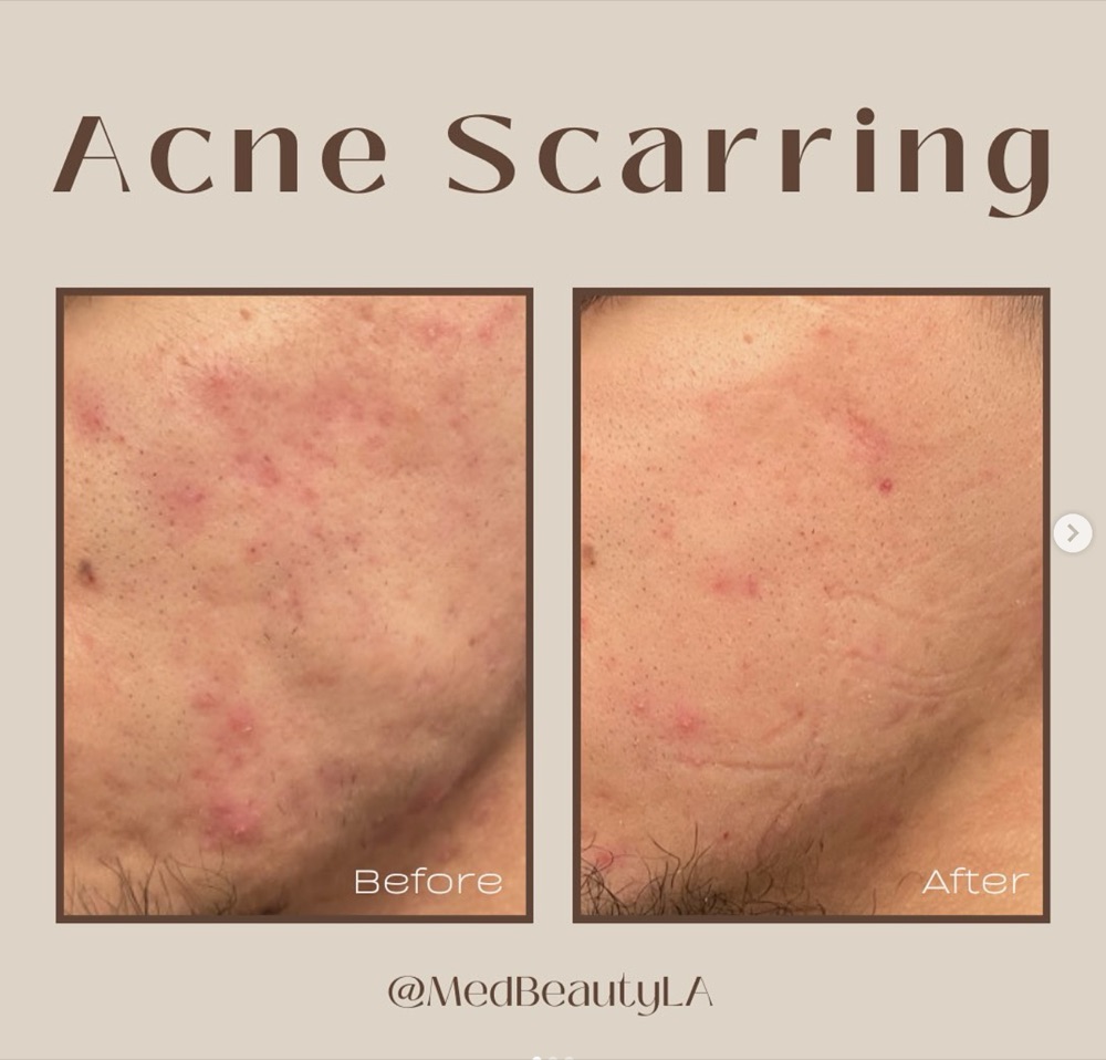 Acne scarring before and after at MedBeautyLA: red marks and uneven texture on the cheek become smoother and calmer