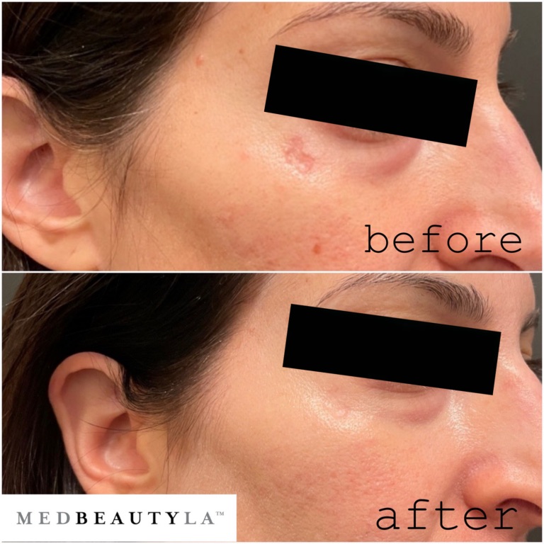 Acne scar before and after at MedBeautyLA: a textured scar on the upper cheek becomes much smoother and less visible