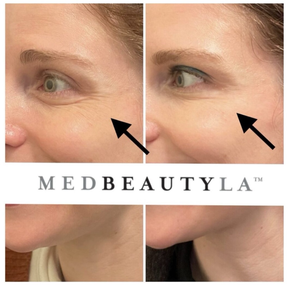 Botox for crow's feet before and after at MedBeautyLA: lines at the outer corner of the eye softened