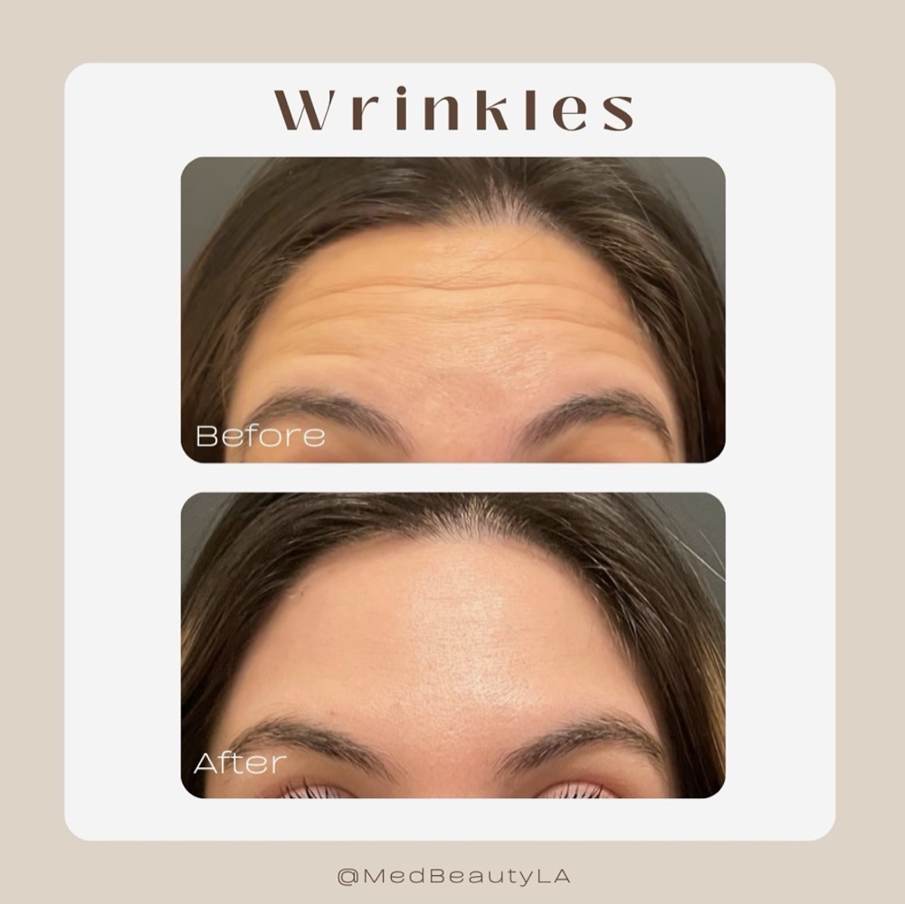 Botox before and after at MedBeautyLA: deep horizontal forehead lines smoothed out