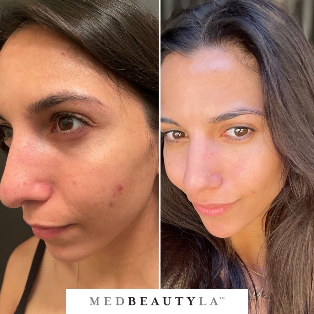 Bridal Skin Bootcamp before and after at MedBeautyLA: breakouts and redness on the cheek and nose give way to clear, glowing skin