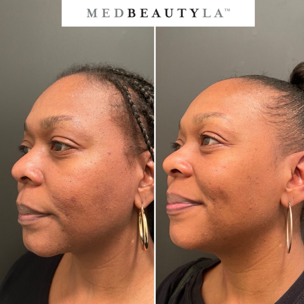 Bridal Skin Bootcamp before and after at MedBeautyLA: dark spots and uneven tone on the cheek and forehead even out