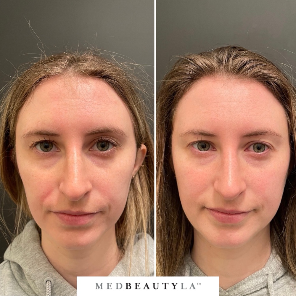 Bridal Skin Bootcamp before and after at MedBeautyLA: redness across the face calms to a clear, even complexion