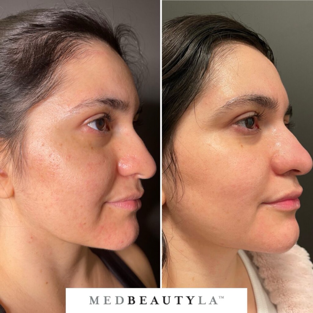 Bridal Skin Bootcamp before and after at MedBeautyLA: redness, bumps and uneven texture on the cheek become smooth and even