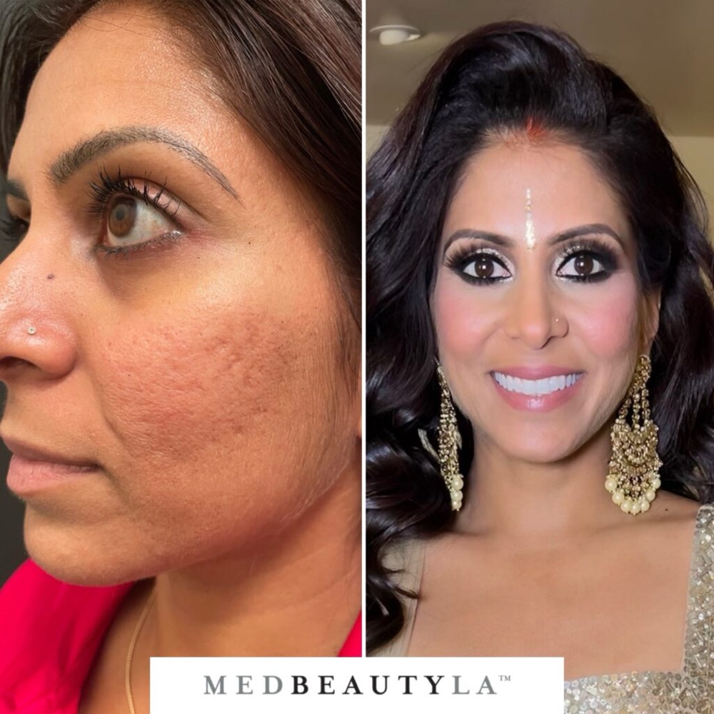 A MedBeautyLA Bridal Skin Bootcamp client before treatment, with acne scarring and uneven tone on her cheek, and after, dressed for her celebration with smooth, glowing skin