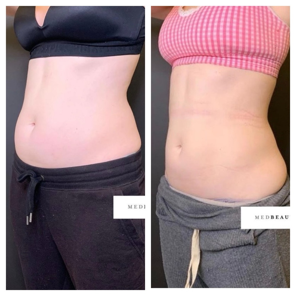 CoolSculpting before and after at MedBeautyLA: a woman's abdomen and flank from the side, visibly flatter and more contoured after three sessions