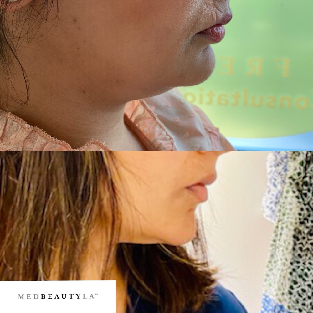 Chin CoolSculpting before and after at MedBeautyLA: side profile showing less fullness under the chin and a more defined jawline after one session