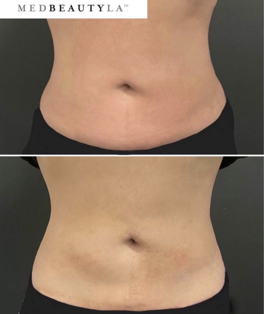 Non-surgical fat reduction before and after at MedBeautyLA: front view of a lower abdomen that is smoother and less rounded after treatment